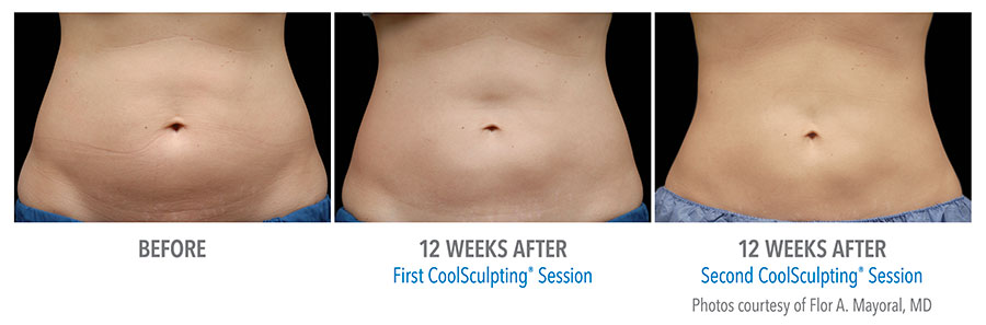 CoolSculpting Before and After – LuminaSkin