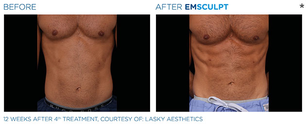 Emsculpt Before and After – LuminaSkin